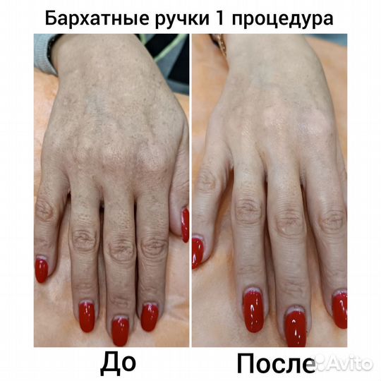 Ищу модель карбокситерапия