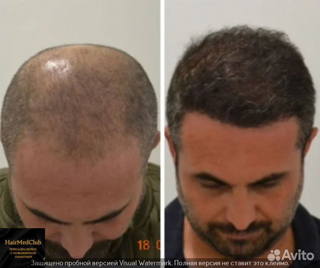 Пересадка волос, бороды Россия/ Турция