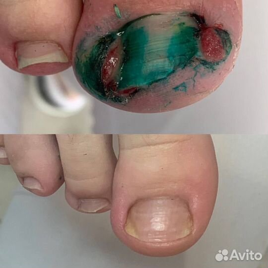 Аппаратный педикюр, подолог, вросший ноготь