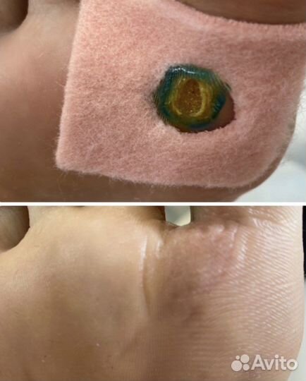 Удаление бородавок