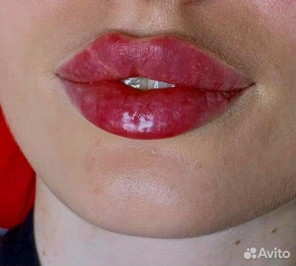 Контурная пластика губ,увеличение губ