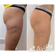 Коррекция фигуры, обертывания, лазерная эпиляция