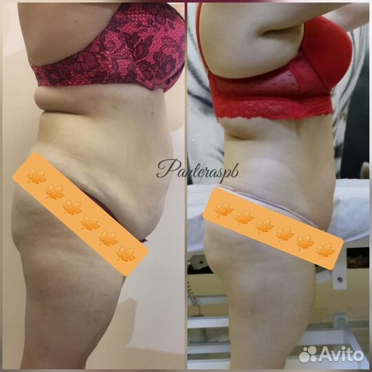 Модель на криолиполиз