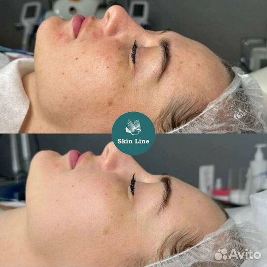 Модели / карбоновый пилинг