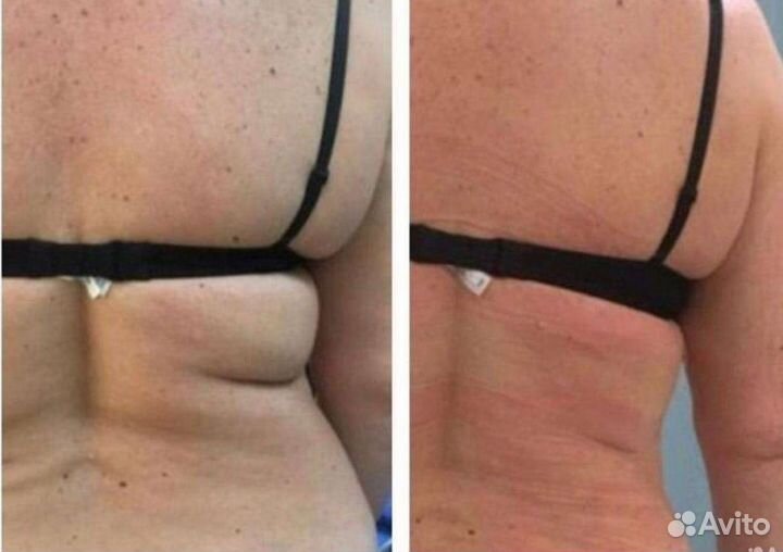 Модели на липолитики