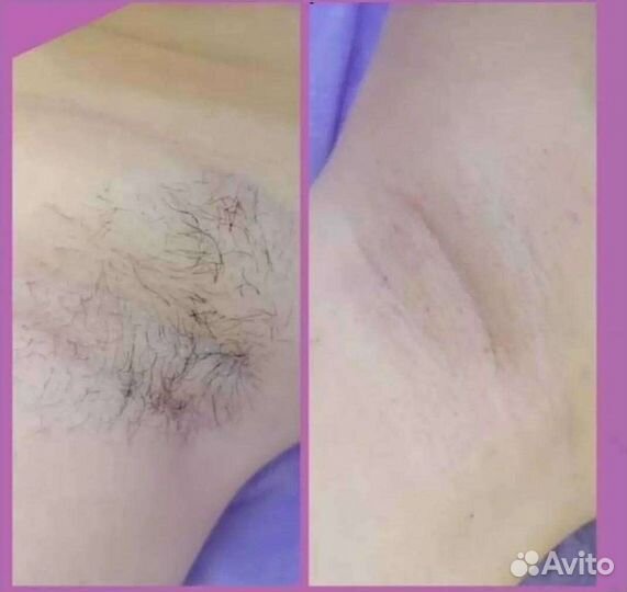 Сахарная депиляция/Шугаринг