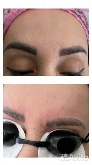 Лазерная эпиляция: бакенбарды