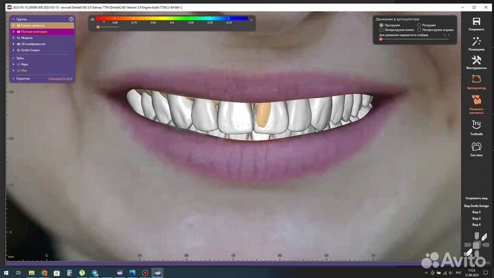 Удалённое моделирование в exocad