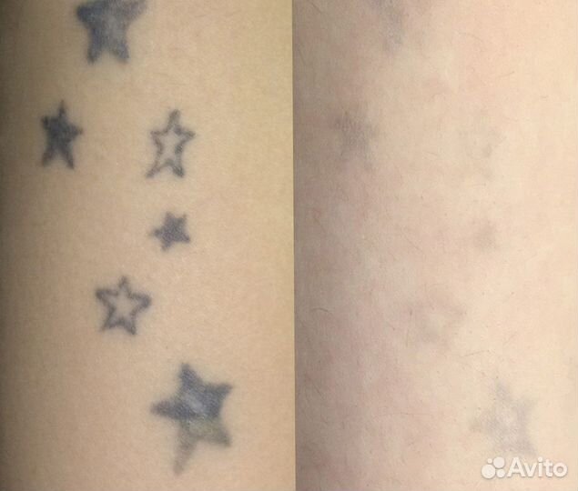 Удаление татуировок