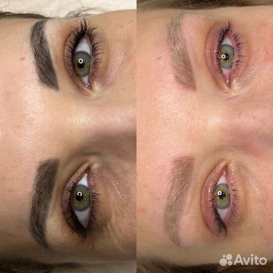 Модели на удаление татуажа лазером