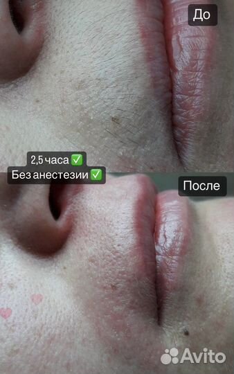 Электроэпиляция