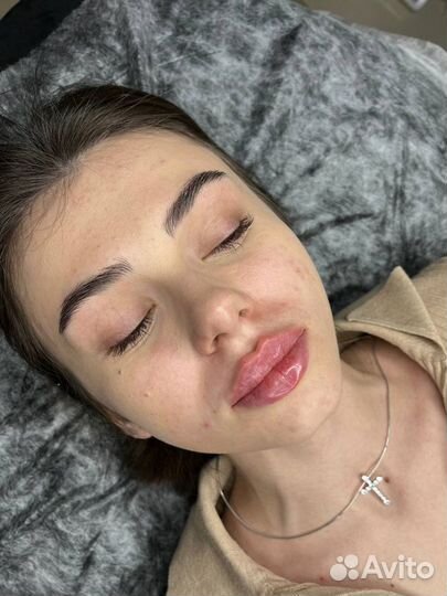 Увеличение губ