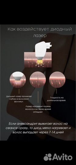 Лазерная эпиляция