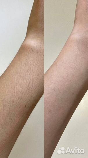 Депиляция Шугаринг