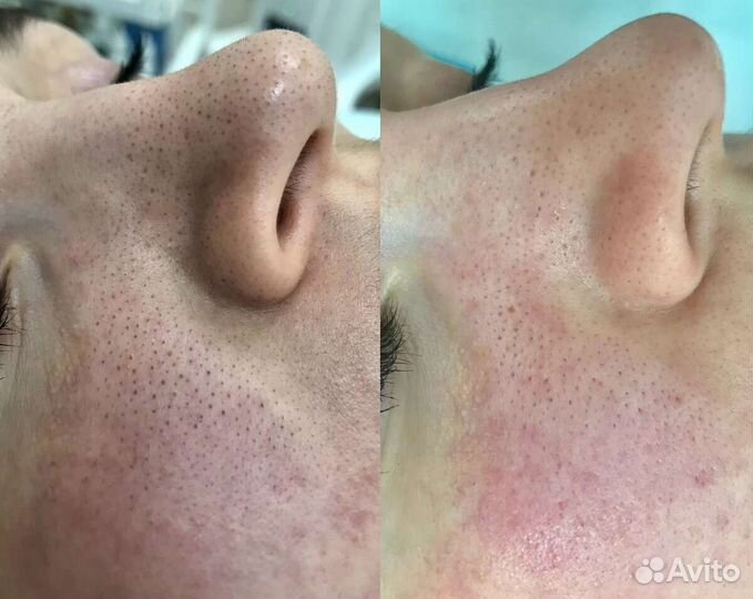 Механическая чистка лица