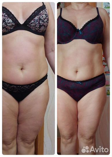 Антицеллюлитный массаж, коррекция фигуры