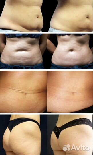 Вакуумный массаж,кавитация,липолиз,rf лицо,тело