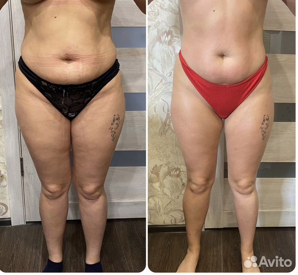 Массаж Аппаратный Ручной медовый