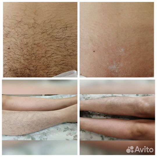 Шугаринг ЖК Цветы сахар/ воск, гл чистка бикини