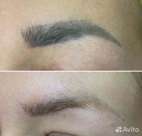 Удаление татуажа и тату лазер / ремувер