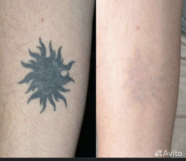 Лазерное удаление татуировок