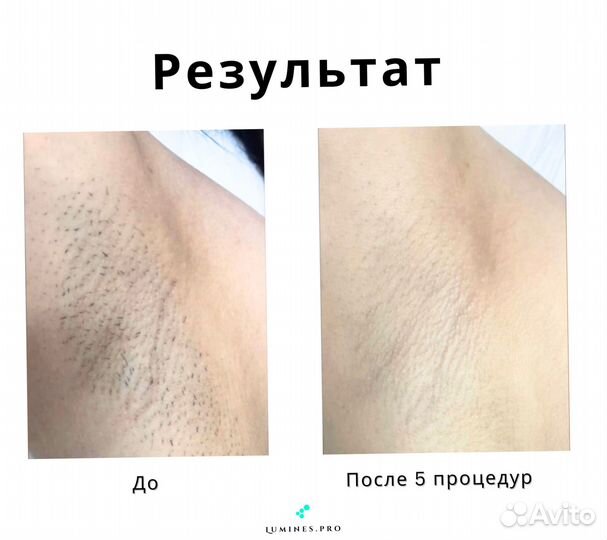 Диодный лазер Lumines’ максван 1200 Вт