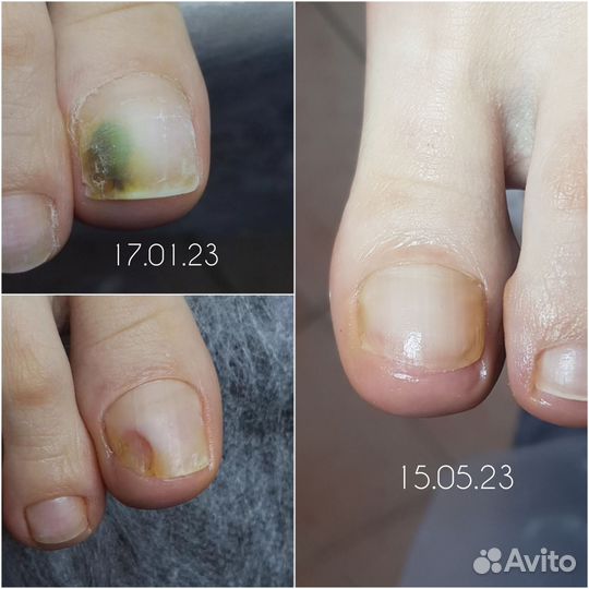 Подолог, медицинский педикюр