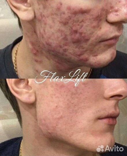 Обучение/курсы косметолог эстетист FlaxLift