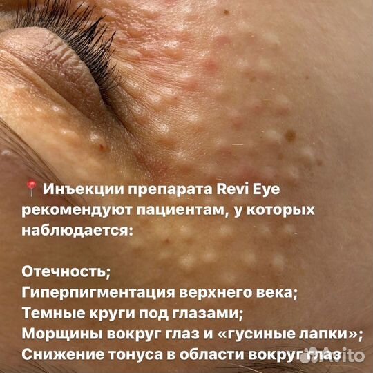 Устранение мешков под глазами