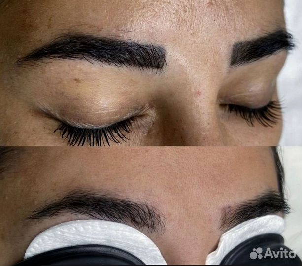 Лазерное удаление тату за одну процедуру*