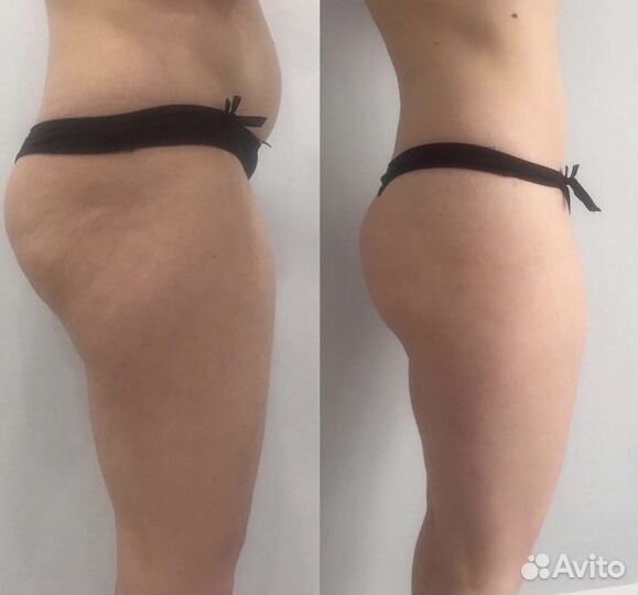 Жиросжигание Фито Гелем /Коррекция фигуры