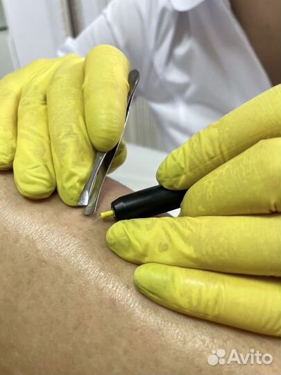 Обучение электроэпиляции