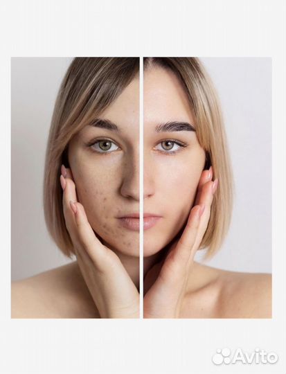 Лазерная ручка для удаления морщин и прыщей