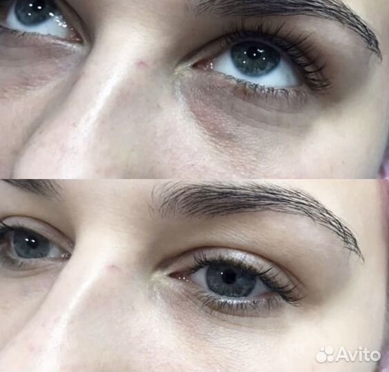 Коррекция носослезной борозды