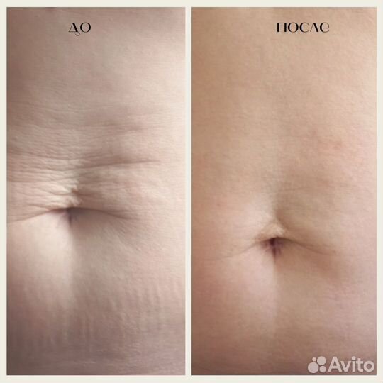 Коррекция фигуры, аппаратный массаж, ручной массаж