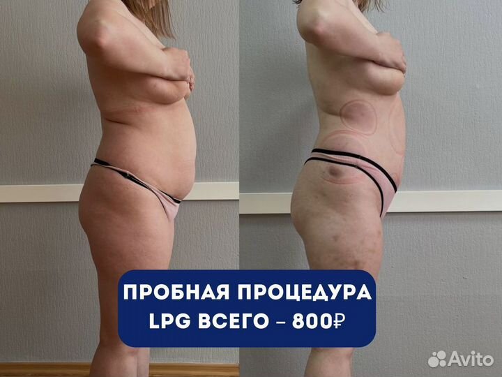 Аппаратный массаж, LPG, вибро и вакуумный массаж