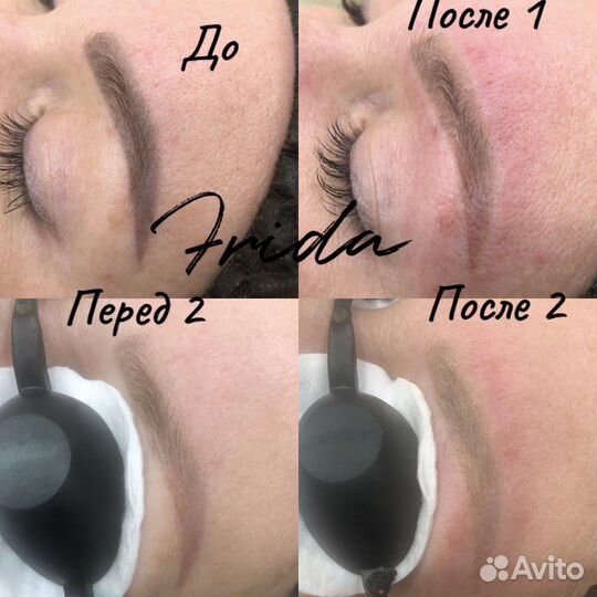 Лазерное удаление татуажа и татуировок