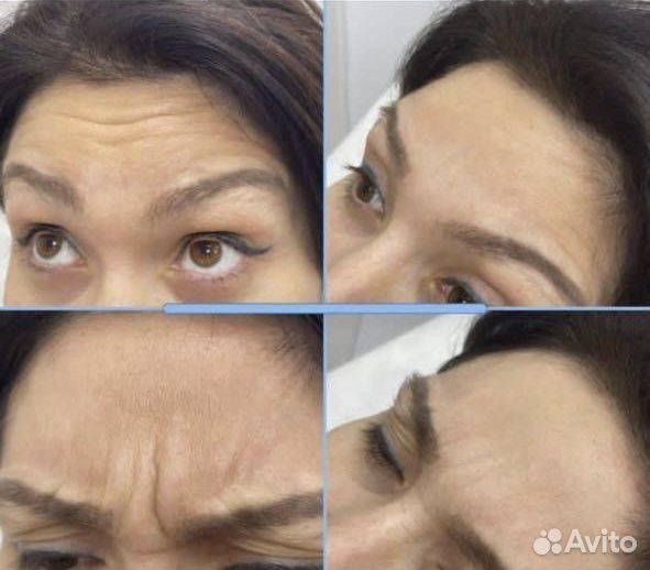 Ботокс лица