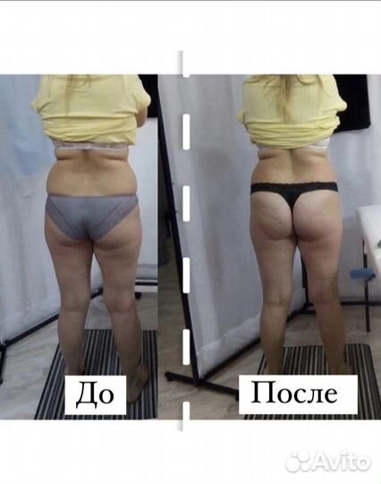 Ищем моделей на подтяжку животика