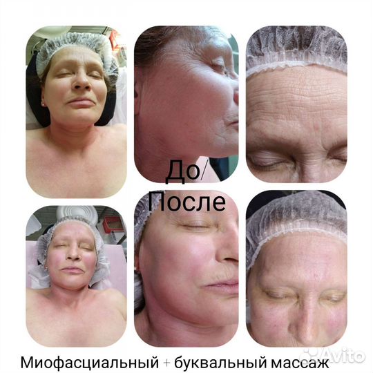 Чистка лица/пилинги/карбокситерапия