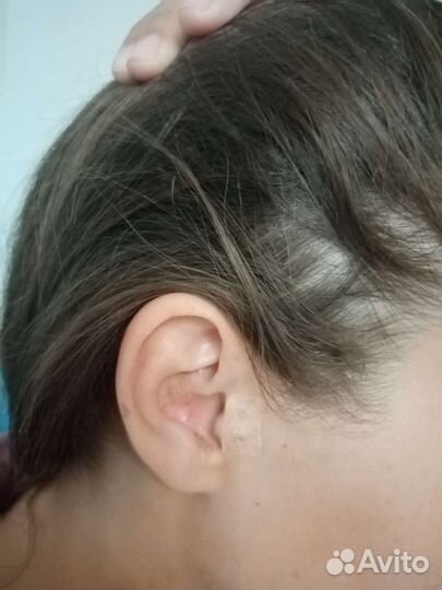 Похудение. Снижение веса микроиглами