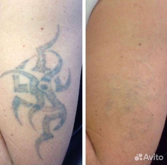 Лазерное удаление татуировок