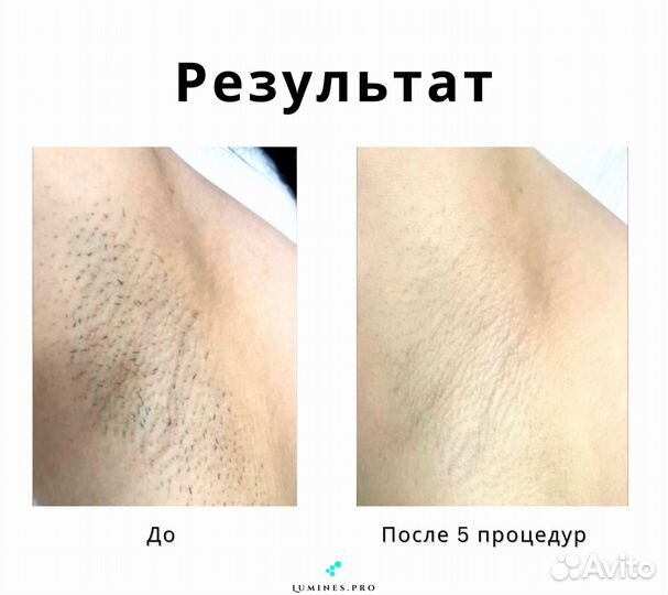 Аппарат для эпиляции Люминес максван 1200вт