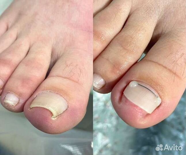 Подолог, педикюр смарт