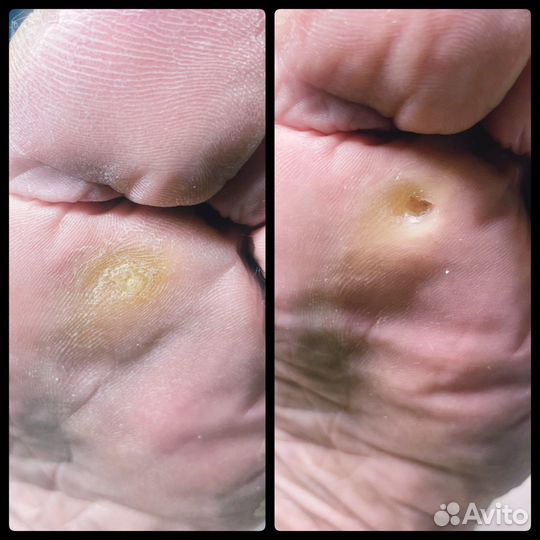 Подолог с выездом на дом для пожилых