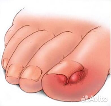 Медицинский педикюр подолог