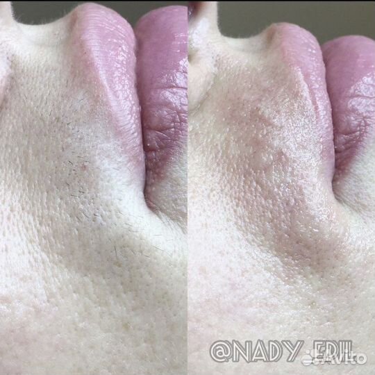 Электроэпиляция Без Боли