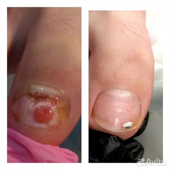 Подолог(сложные ноги,трещины,вросший но