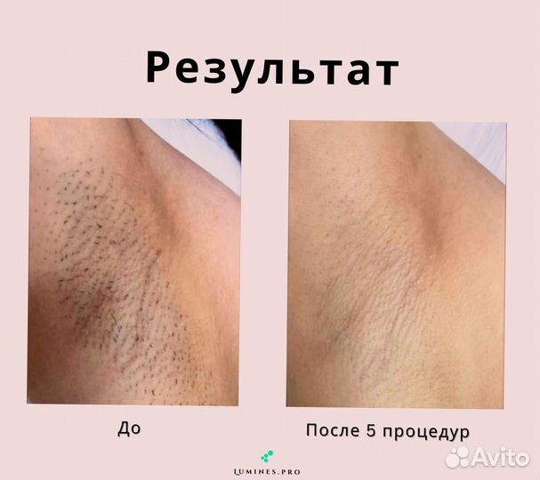 Аппарат для эпиляции Люминес’ максван 1200