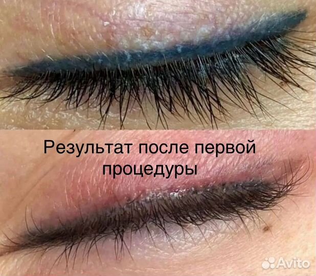 Лазерное удаление татуажа и тату в Москве